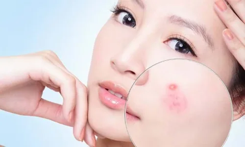 Giải đáp thắc mắc: mụn ẩn dưới da có nên nặn?