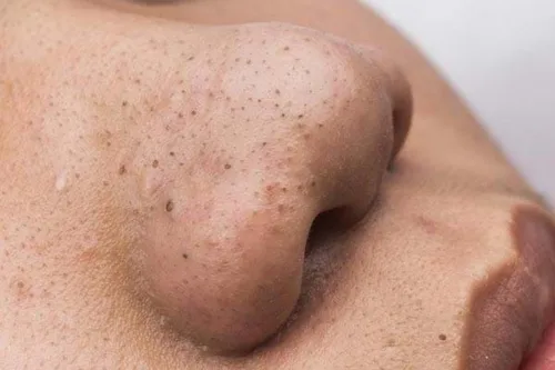Phân biệt các loại mụn, nguyên nhân hình thành