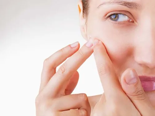 Tiết lộ 7 bước nặn mụn đúng cách, an toàn mà không viêm nhiễm